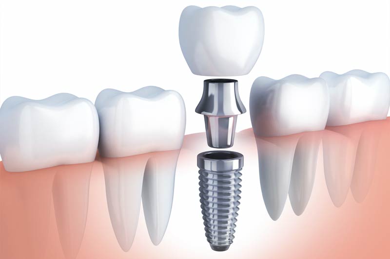 Implants Dentist in Des Moines