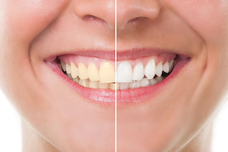 Teeth Whitening in Des Moines