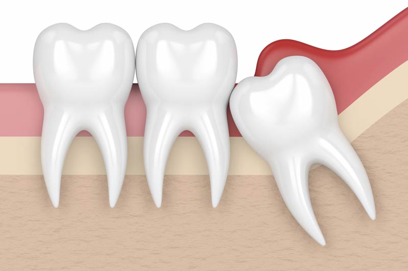 Wisdom Tooth Removal in Des Moines